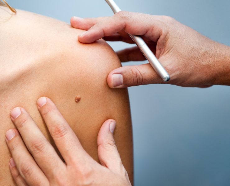 Nevi, come riconoscere quelli pericolosi